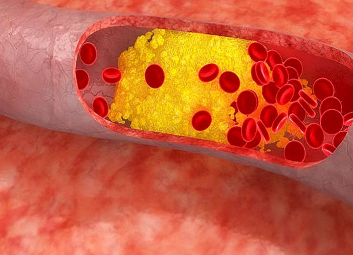Как снизить уровень холестерина естественным способом