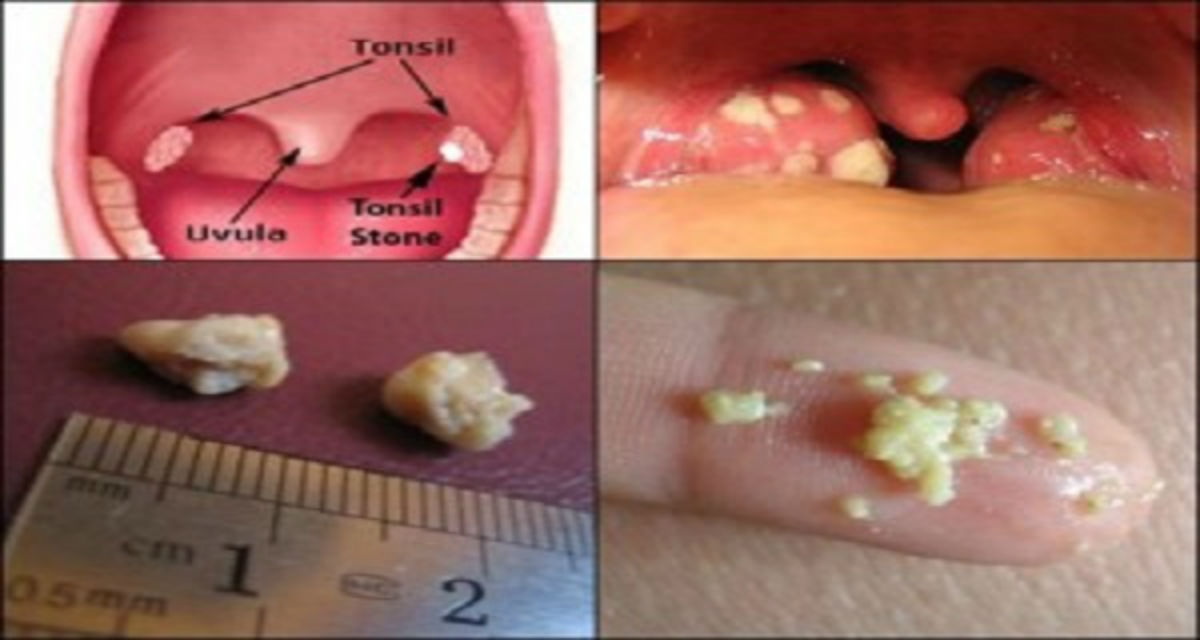 Вот, как избавиться от тонзилитных пробок без операций