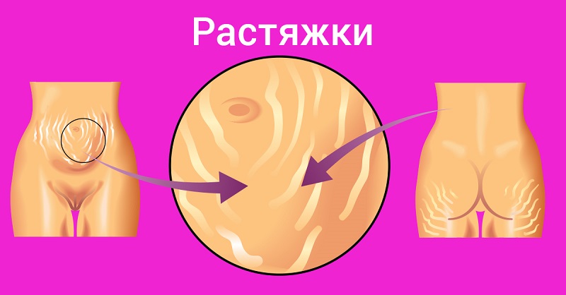 Куда делись растяжки? Копеечное средство из аптеки сделало кожу божественной! За 2 недели пропали!