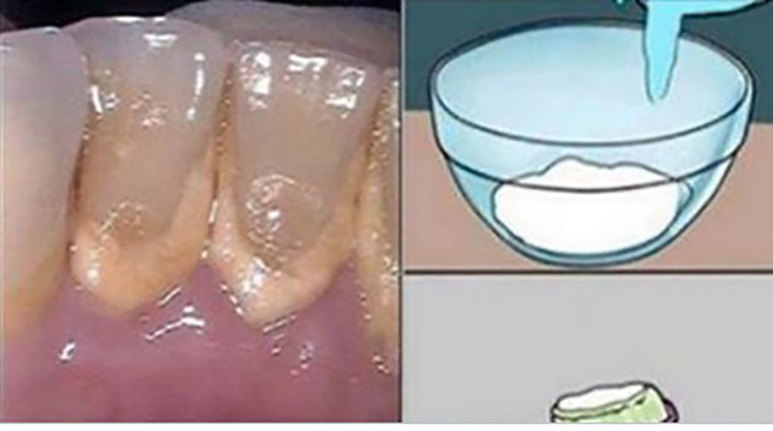 Это средство для полоскания рта удаляет зубной налет за 2 минуты!