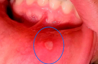 Как быстро избавиться от язв ротовой полости с помощью этих 5 домашних средств