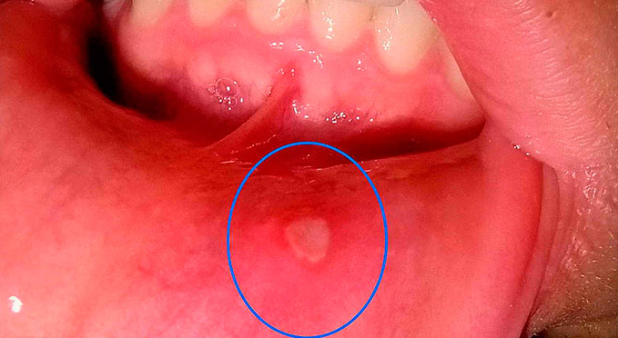 Как быстро избавиться от язв ротовой полости с помощью этих 5 домашних средств