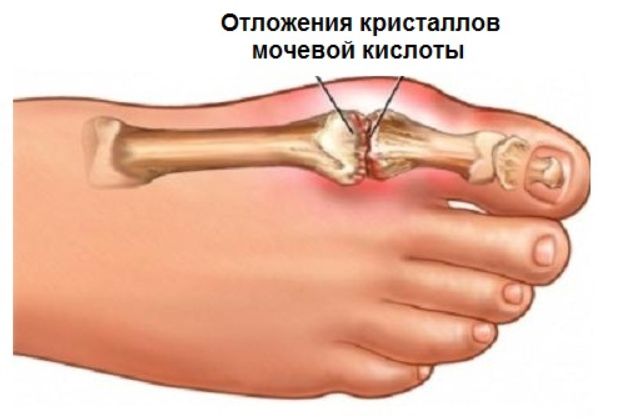 Избавьтесь от мочевой кислоты и вылечите подагру с помощью 10 натуральных средств!