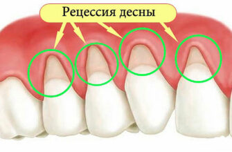 Как устранить оголение шейки зуба и не допустить потерю зубов? Помогут 5 эффективных рецептов!