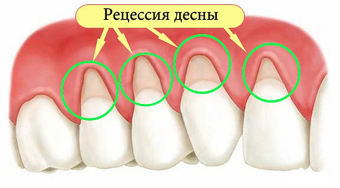 Как устранить оголение шейки зуба и не допустить потерю зубов? Помогут 5 эффективных рецептов!