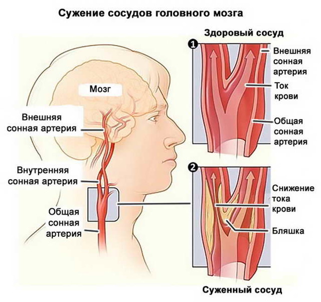 Сужение сосудов головного мозга, лечение и симптомы суженных сосудов головы