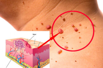 Что делать с папилломами на шее