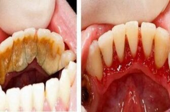 Будьте сами себе стоматологом! Вот трюки для удаления зубного камня