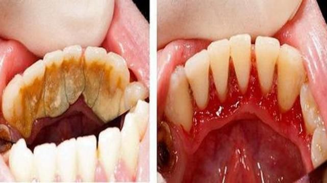 Будьте сами себе стоматологом! Вот трюки для удаления зубного камня