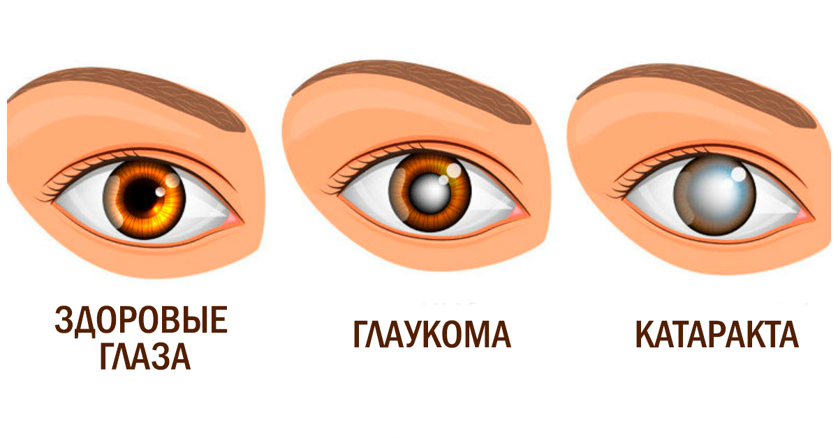 Глаукома картинки для презентации