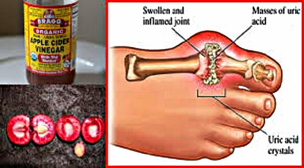 Вот как устранить кристаллизацию уксусной кислоты из вашего тела, чтобы бороться с болью в суставах и подагрой!