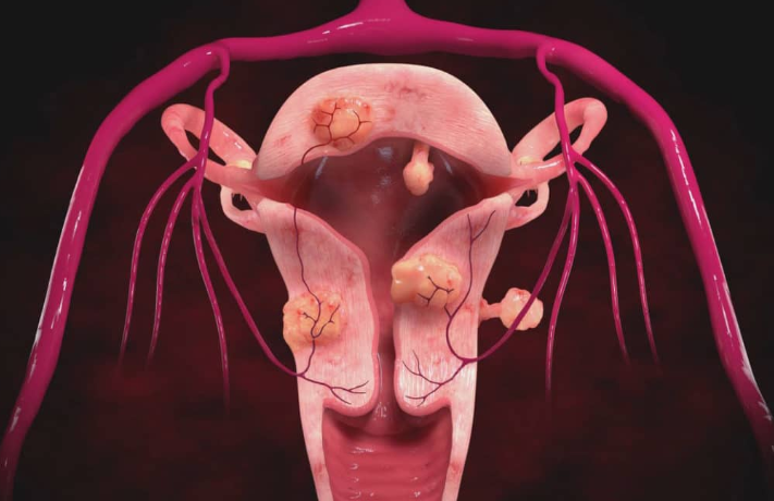 Как вылечить миому матки без гормональной терапии и избежать операции