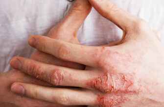 Трескается кожа на руках? Причины и лечение