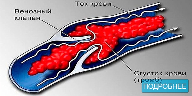 Не хочешь тромбов, просто пей этот коктейль!