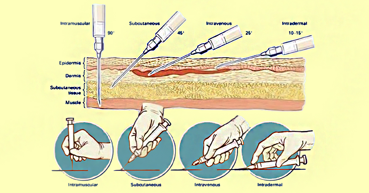 Места внутрикожной инъекции схема