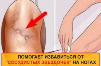 Уничтожаем «СОСУДИСТЫЕ ЗВЕЗДОЧКИ» на ногах без операций и лекарств!