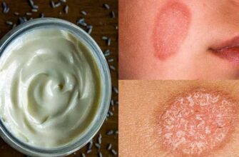 Древний рецепт лечебного крема быстро исцелит от кожных заболеваний, даже от экземы и псориаза!