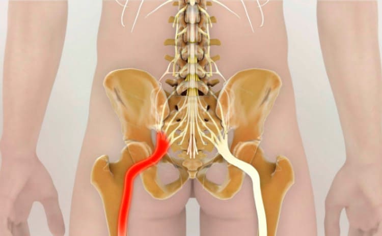 Как разблокировать седалищный нерв: 2 простых способа