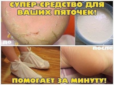 Домашнее СРЕДСТВО ДЛЯ ПЯТОК! ПОМОГАЕТ ЗА МИНУТУ!