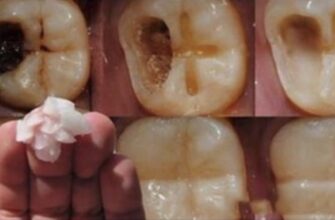 Вот 5 шагов, чтобы остановить кариес и спасти свои зубы Можете удалить номер стоматолога