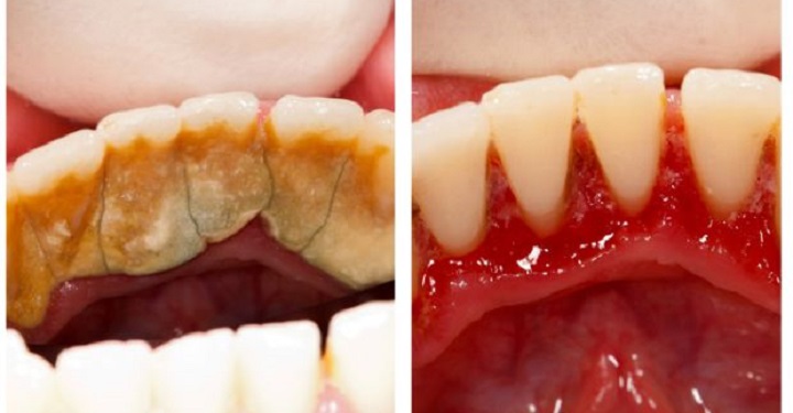1 классный способ избавиться от зубного камня самому и дома!