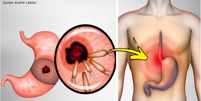 Вот как избавиться от бактерий, вызывающих изжогу, язву и вздутие живота