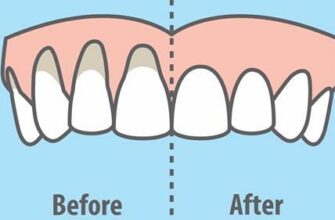 10 легких способов исцеления оголенных десен естественным способом