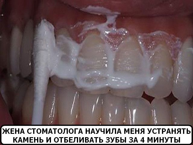 Жена стоматолога научила меня устранять зубной камень и отбеливать зубы за 4 минуты