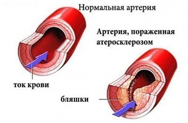 Как очистить сосуды валерианой с медом