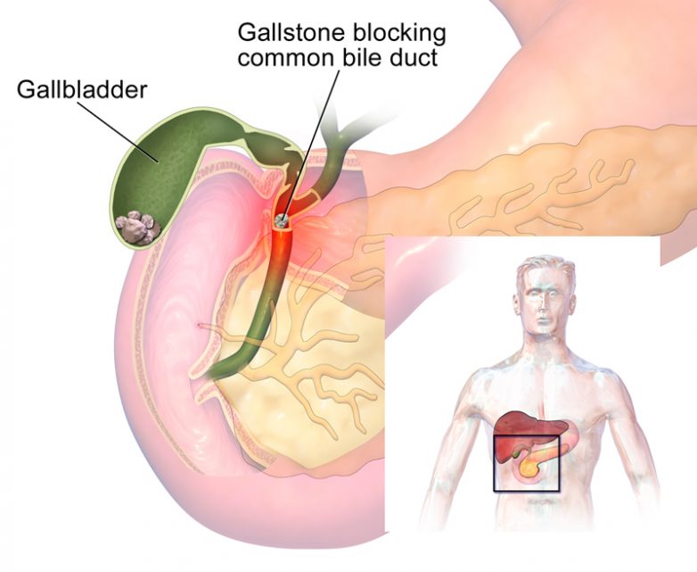 Как прожить без камней в желчном пузыре