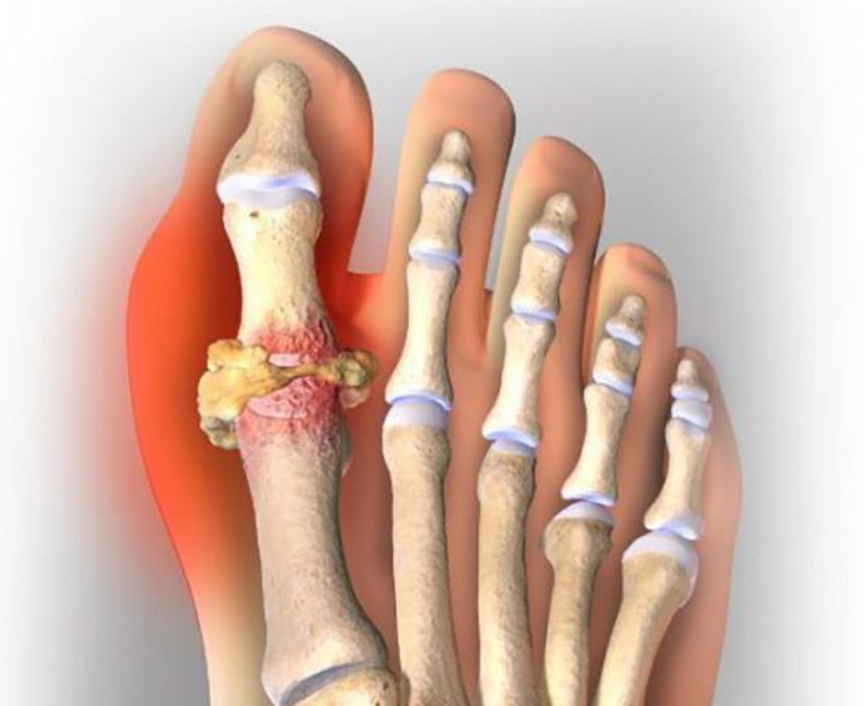 Подагра: как лечить правильно