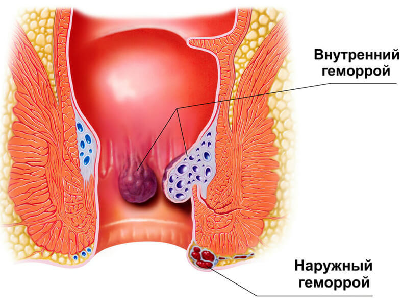 Как узнать, у вас – геморрой... или что-то серьезное?