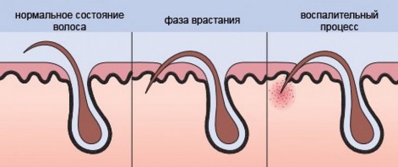 6 лучших способов избавиться от вросших волос