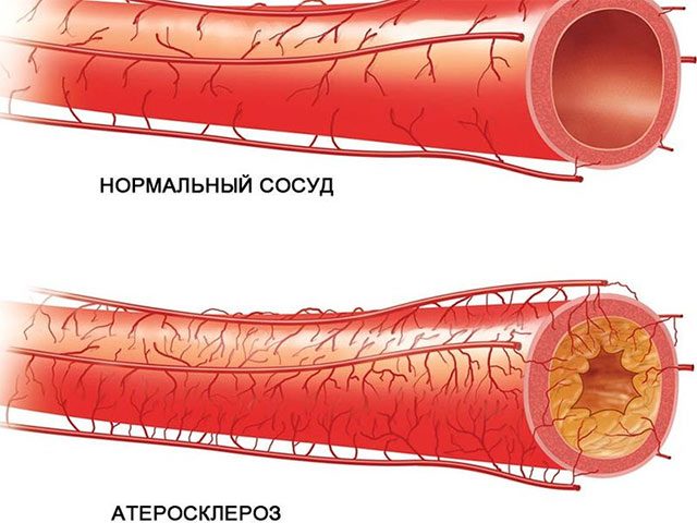 Почему возникает атеросклероз?