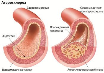 Почему возникает атеросклероз?