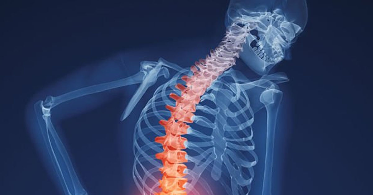 Остеопороз: симптомы, причины и лучшие способы укрепления костей