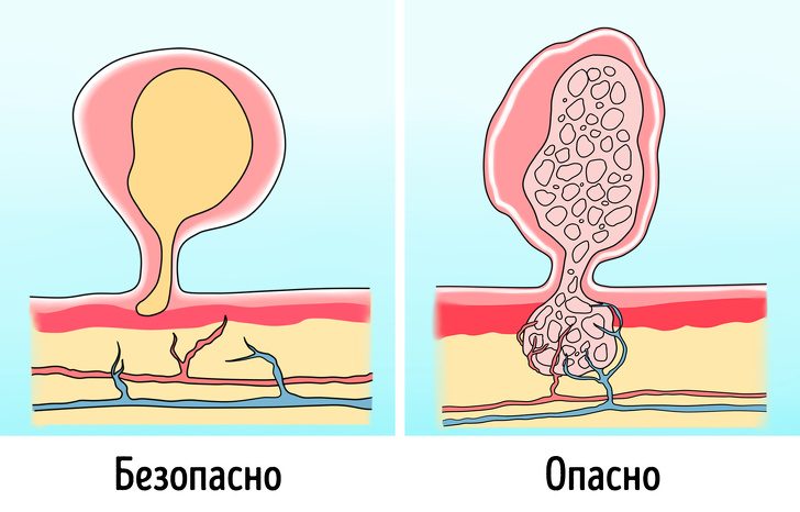 Как можно отличить родинки и прыщи от опасных пятен и наростов