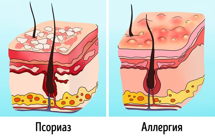 Как можно отличить родинки и прыщи от опасных пятен и наростов