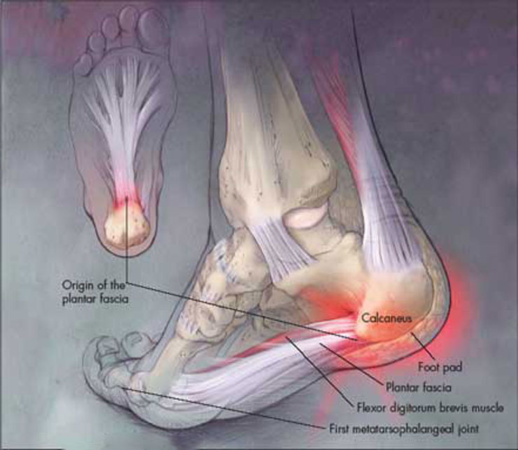Плантарный фасциит: Причины и риски появления