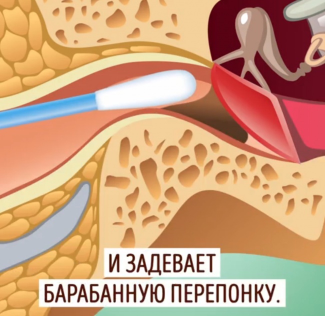 Почему нельзя чистить уши ватными палочками