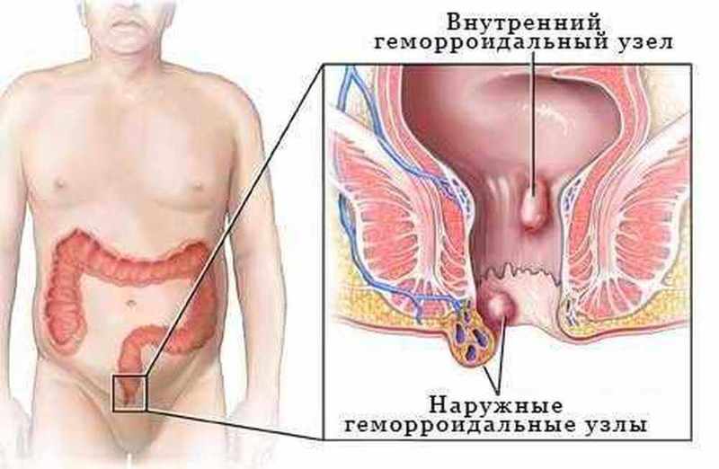 Варикоз и геморрой. 2 заболевания – одно решение 