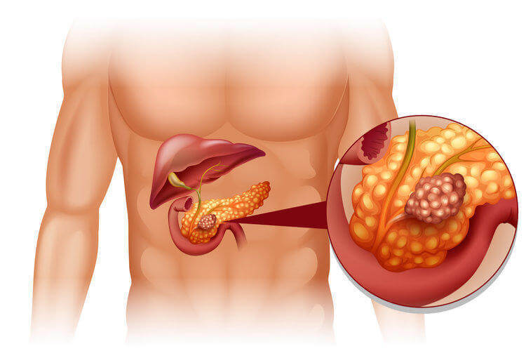 Рак поджелудочной железы: 10 ранних симптомов, которые нельзя игнорировать