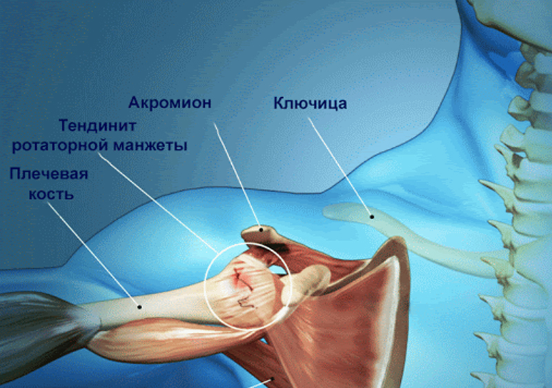 Плечевой тендинит: 6 упражнений от боли в плече