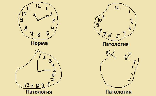 Как проверить себя на болезнь Альцгеймера