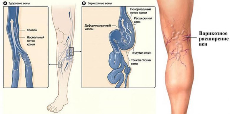 Как быть, если вас мучают судороги в ногах?