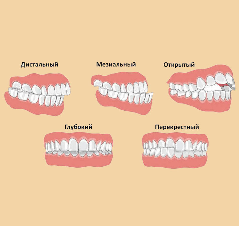 ВАЖНО! Наш прикус и проблемы с опорно-двигательным аппаратом связаны!