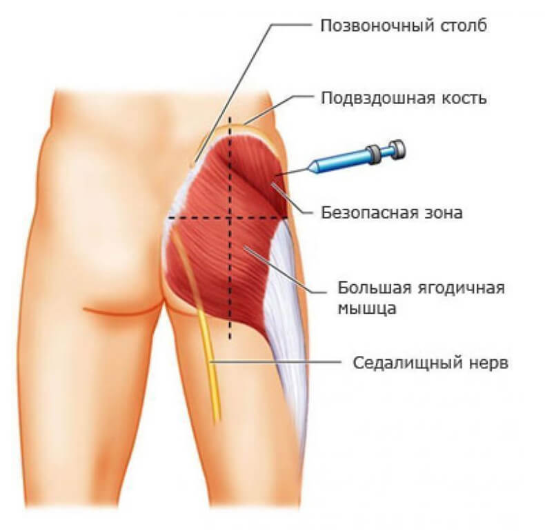 Как правильно делать инъекции? Сохраните себе чтобы знать!