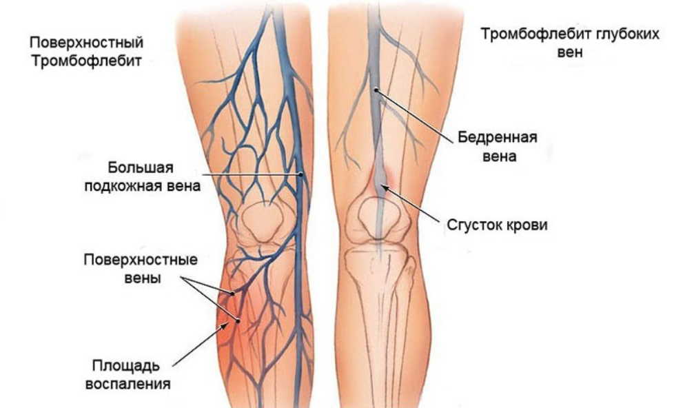 Тромбофлебит — исцеление без операции!