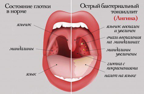 8 советов для тех, кто часто болеет ангиной