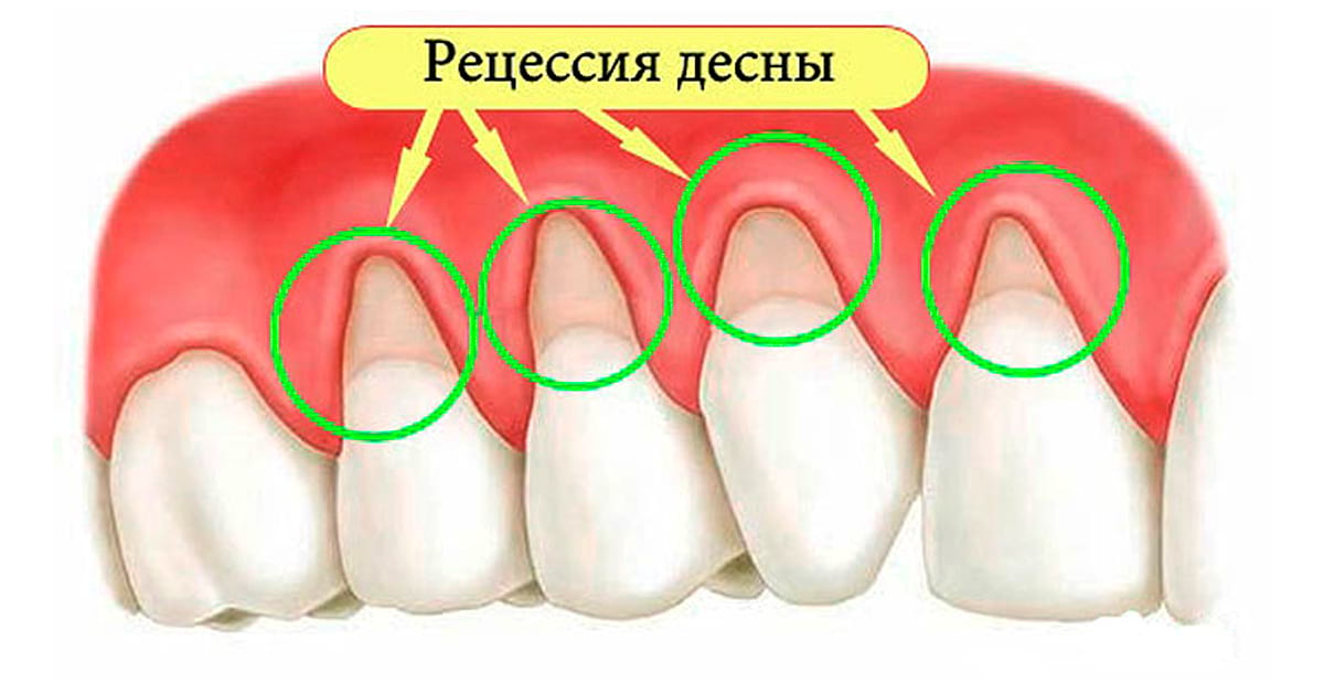 Рецессия десен: 4 домашних средства для быстрого устранения!